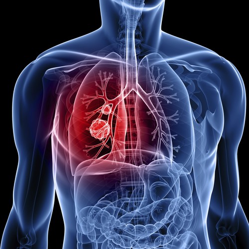 Jakie są symptomy raka płuc?