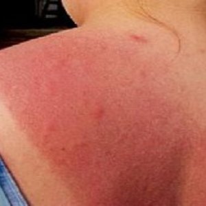 Leki przeciwhistaminowe