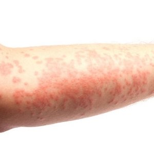 Ochrona przed słońcem