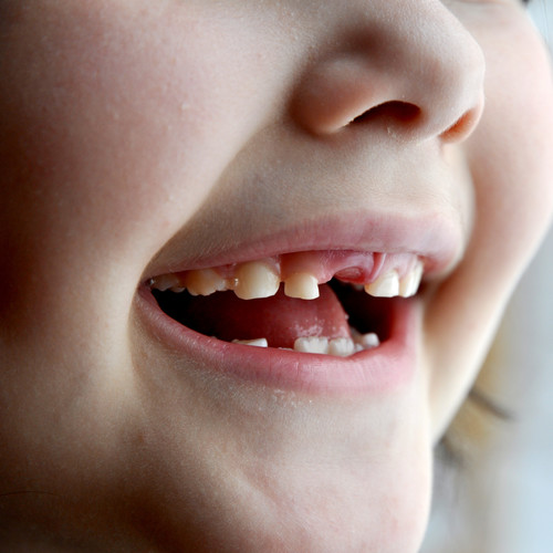 Jakie są przyczyny i objawy zębiaka?