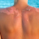 Jak złagodzić wakacyjne oparzenia słoneczne?