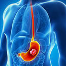 Sposoby na zapobieganie rakowi jelita grubego