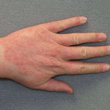 Jakie są przyczyny wyprysku kontaktowego?