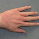 Jakie są przyczyny wyprysku kontaktowego?