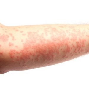 Objawy wyprysku kontaktowego