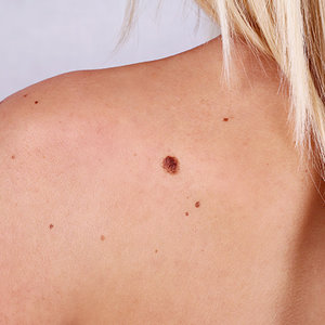 Rogowacenia słoneczne