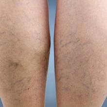 Naturalne sposoby na żylaki podudzi